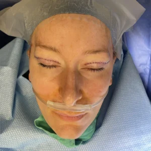 Birds eye view of both incisions. Note gentle technique.