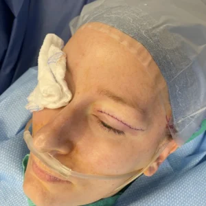 Closure of upper eyelid incision. Please note use of fine, non-inflammatory sutures.