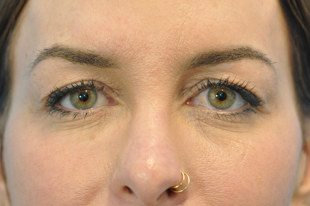 before image